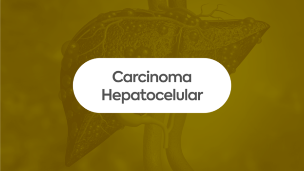 Webserie Carcinoma Hepatocelular – Do diagnóstico ao tratamento